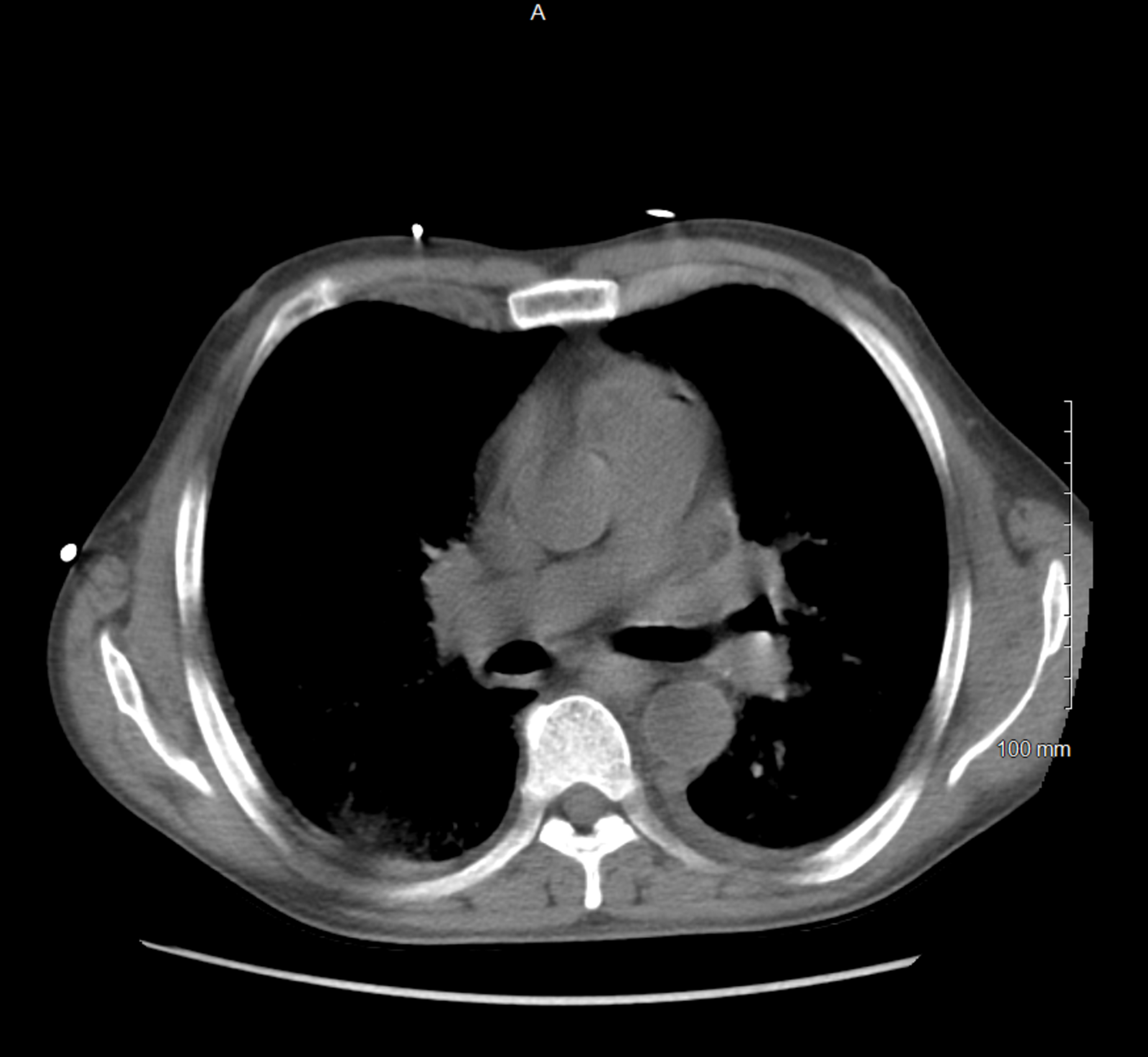 Cureus | Disseminated Histoplasmosis Presenting as Acute Respiratory ...