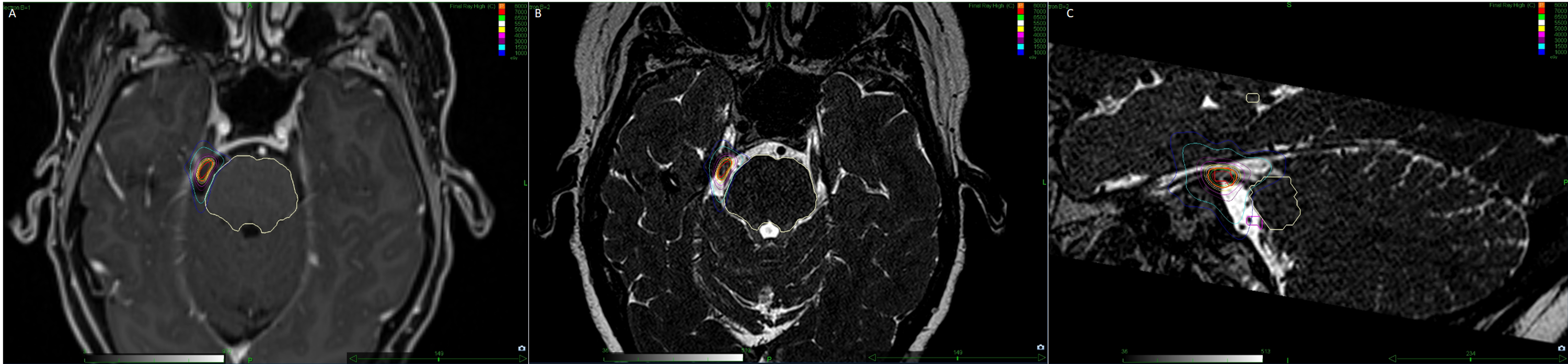 Cureus Treatment of Trigeminal Neuralgia With Stereotactic Radiosurgery Improved Symptoms of