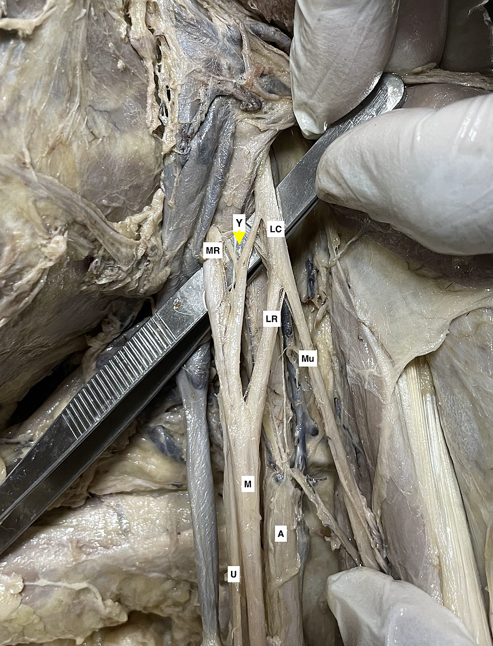-A-cadaveric-specimen-of-left-axilla-with-brachial-plexus-showing-a-"Y"-shaped-supernumerary-root-(yellow-arrowhead),-arising-from-the-lateral-cord-(LC)-and-the-medial-root-(MR)-of-the-median-nerve-(M).-The-axillary-artery-(A),-lateral-root-(LR)-of-the-median-nerve,-musculocutaneous-nerve-(Mu),-and-ulnar-nerve-(U)-can-be-seen-in-the-adjacent-region.