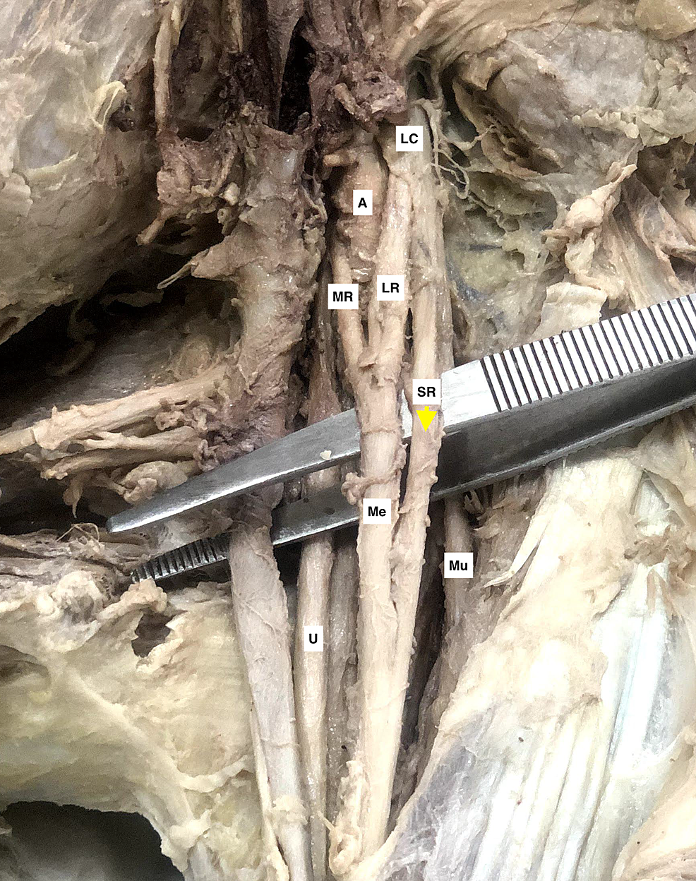 A-cadaveric-specimen-of-left-axilla-with-brachial-plexus-showing-a-thick-tubular-supernumerary-root-(SR,-yellow-arrowhead)-originating-from-the-lateral-aspect-of-the-lateral-cord-(LC)-and-blending-distally-with-the-median-nerve-(M)-after-its-formation.-The-axillary-artery-(A),-lateral-root-(LR),-and-medial-root-(MR)-of-the-median-nerve-(M),-musculocutaneous-nerve-(Mu),-and-ulnar-nerve-(U)-can-be-seen-in-the-adjacent-region.