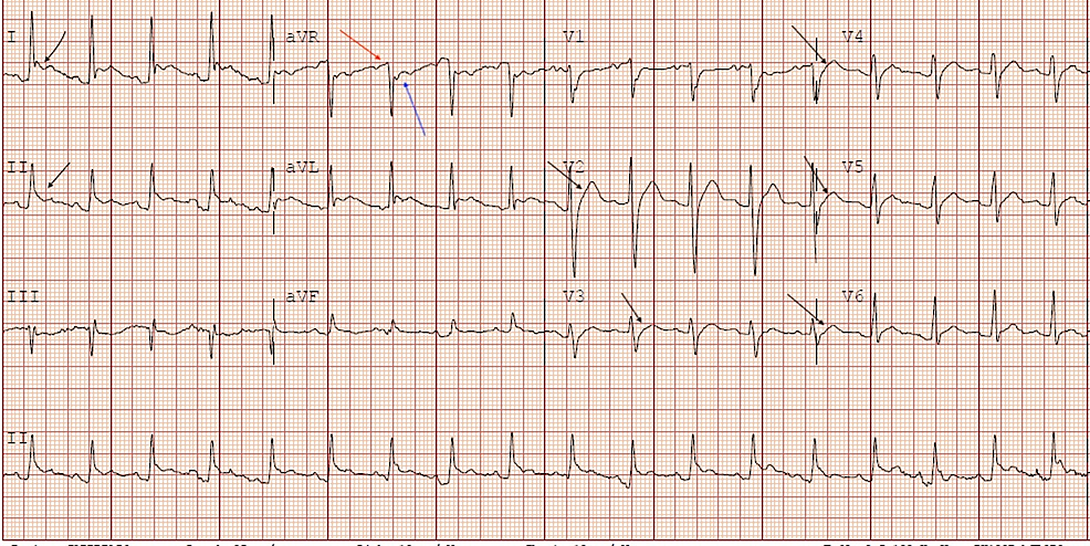 Cureus | Acute Pericarditis Secondary to COVID-19 Infection