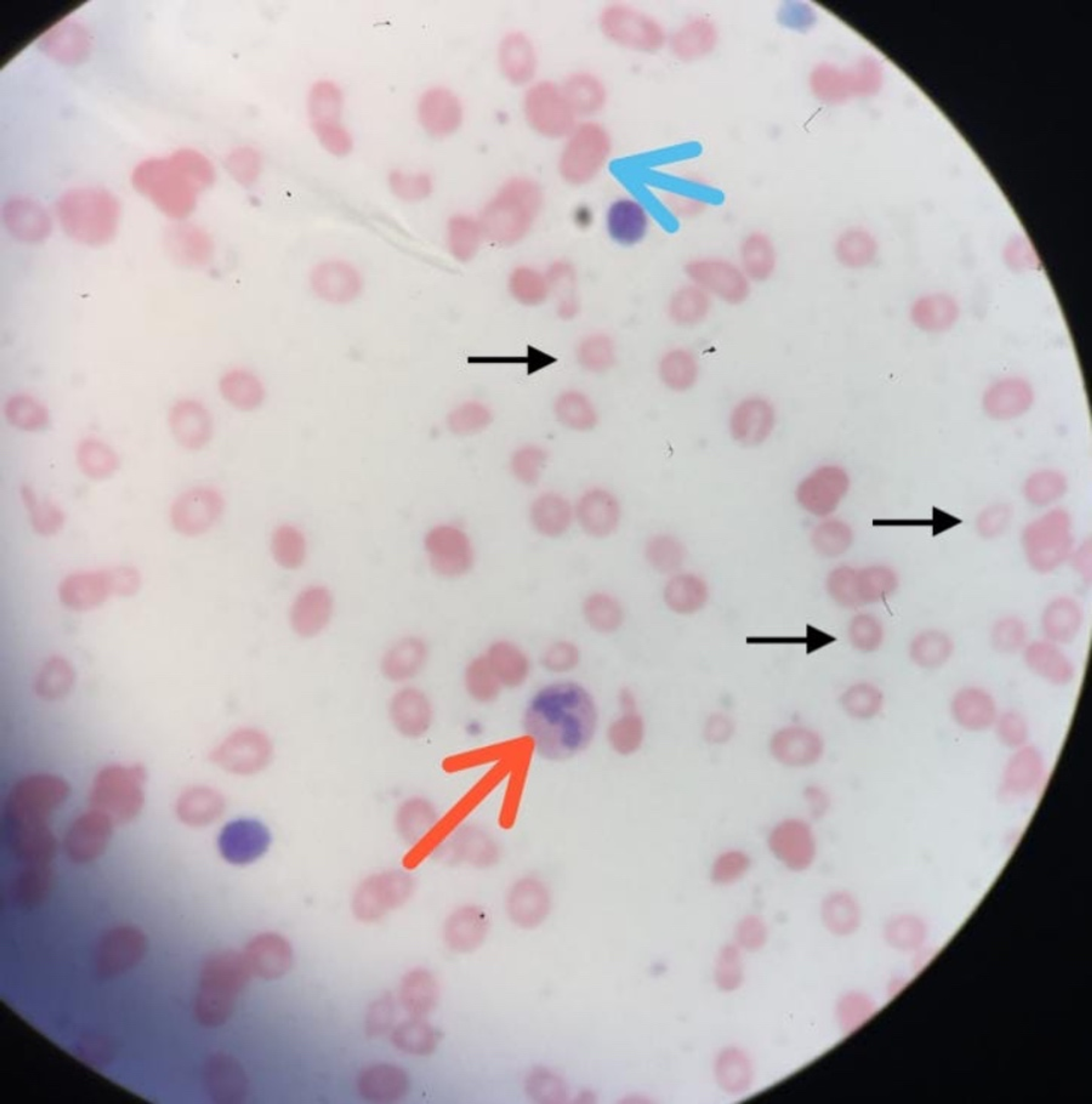 Cureus Microcytic Anemia Hiding Vitamin B12 Deficiency Anemia