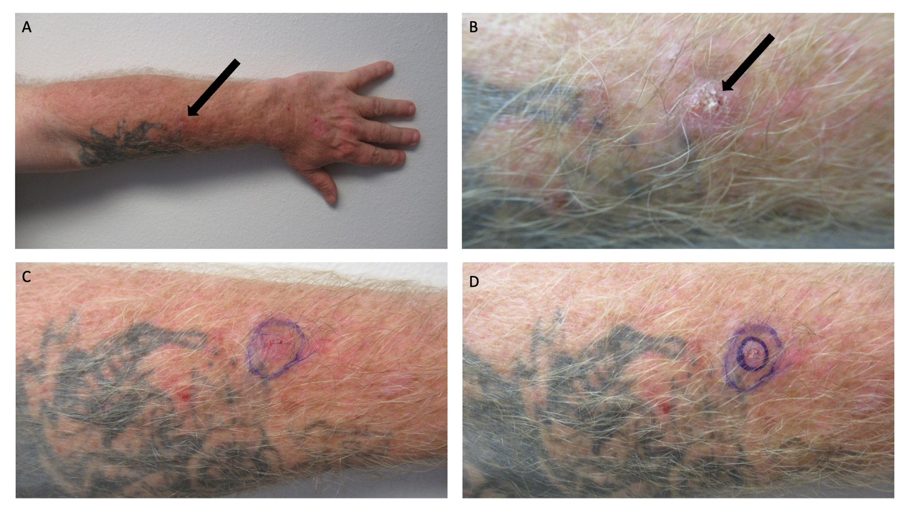 Cureus | Squamous Cell Carcinoma and Tattoo: A Man With a Tattoo-Associated  Squamous Cell Carcinoma and Review of Benign Tumors, Lymphoid Conditions,  and Malignant Neoplasms Occurring Within a Tattoo | Article