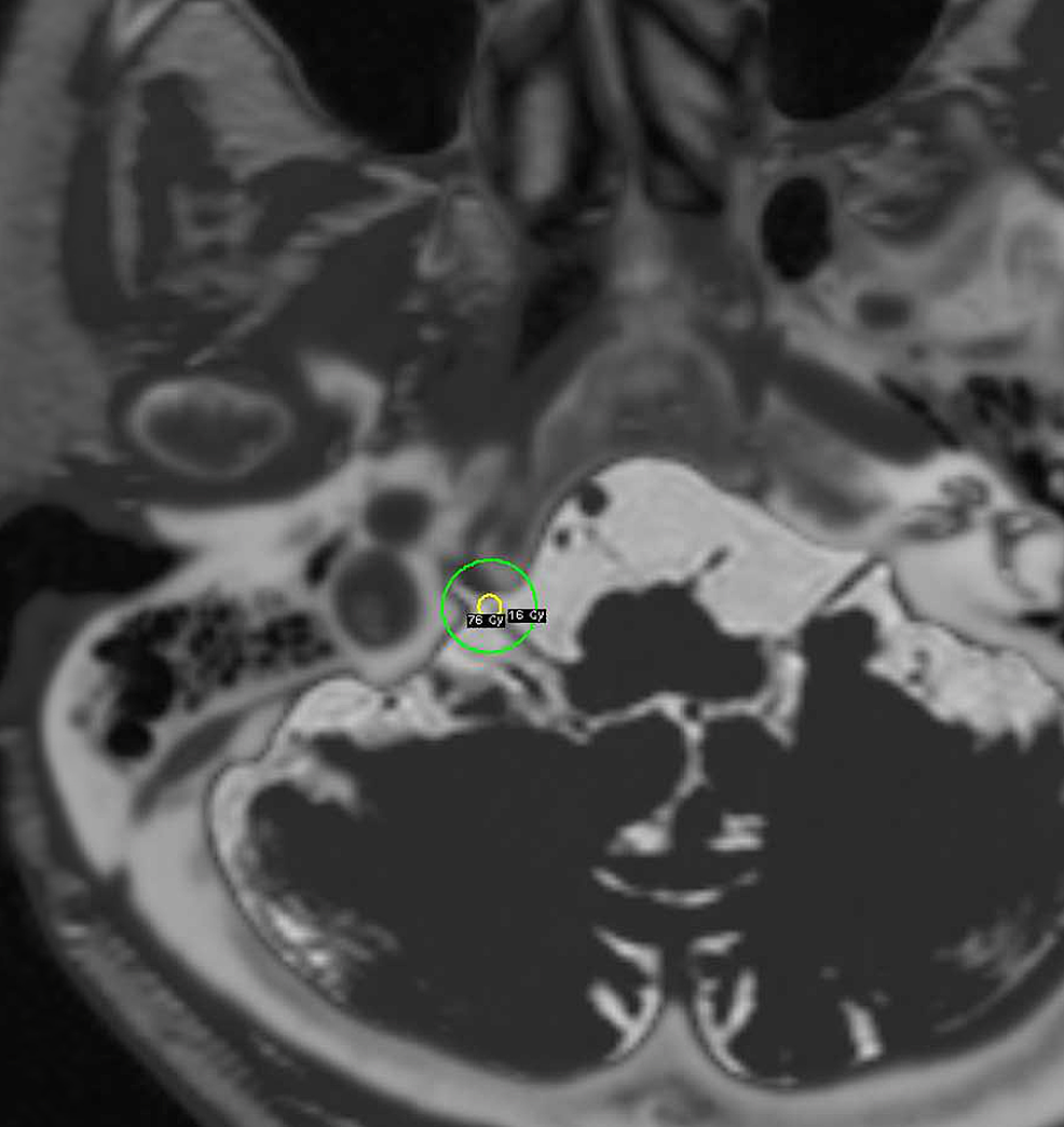 Cureus Gamma Knife Radiosurgery for Concurrent Trigeminal Neuralgia