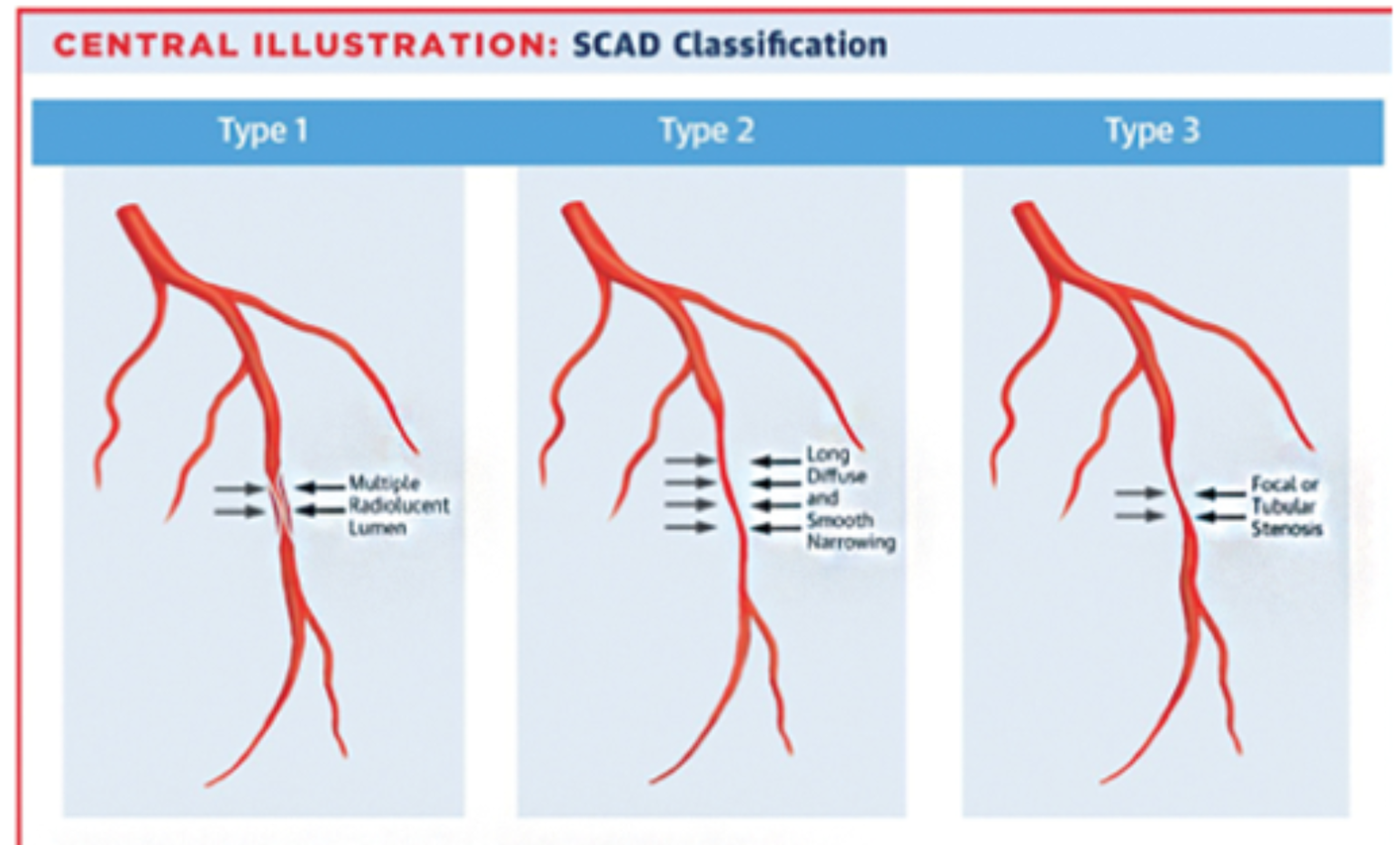 Cureus The Destabilized Artery A Case of Spontaneous Coronary Artery