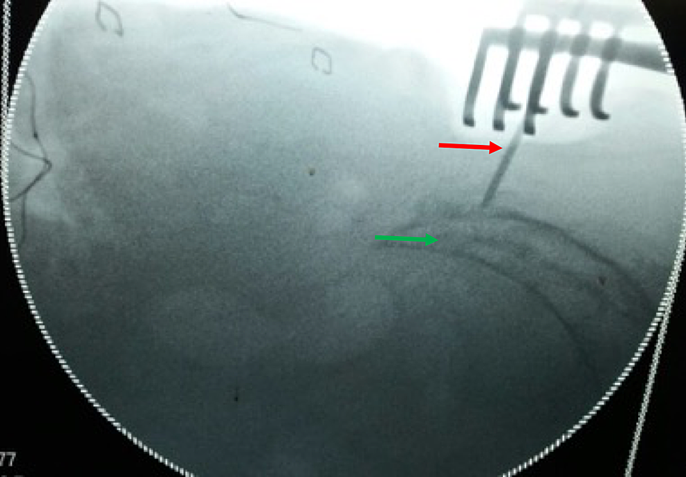 Radiological-marking-of-the-proximal-extent-of-the-tumor:-Green-arrow-(Marked-with-a-‘K’-wire:-Red-arrow).