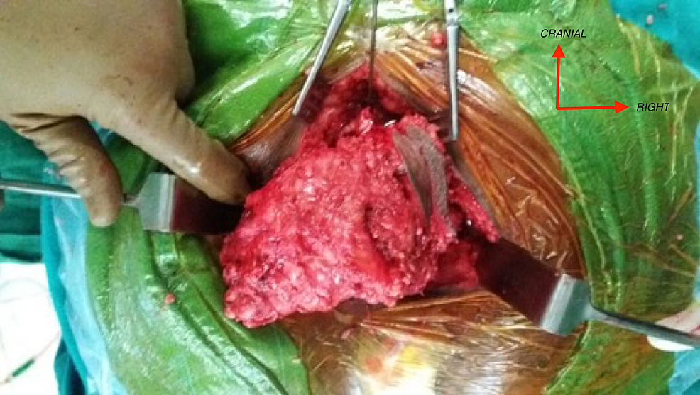 Intraoperative-images-of-tumor-resection.-The-tumor-appears-well-circumscribed-and-measured-12.5-x-7.5-x-8.5-cm-with-attached-pubococcygeal-muscle.