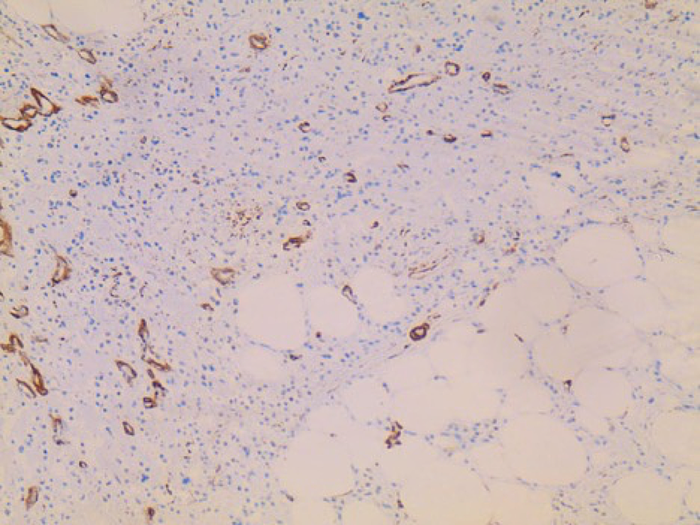 H&E-staining-of-the-mass.-The-tumor-is-composed-of-cells,-which-are-rich-in-cytoplasm-and-show-pale,-vesicular,-and-irregular-nuclei.-The-tumor-cells-are-embedded-in-a-collagen-rich-extracellular-matrix-and-display-no-signs-of-regression.