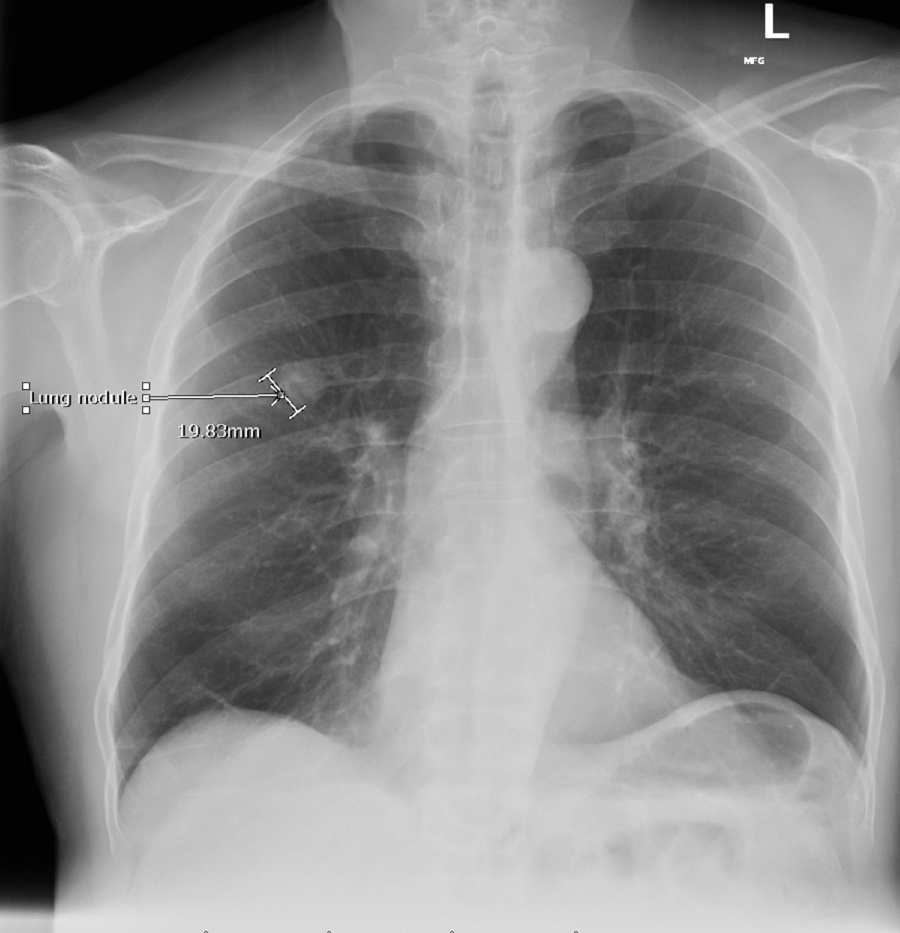 Cureus A Case Report on Atypical Presentation of Metastatic Prostate