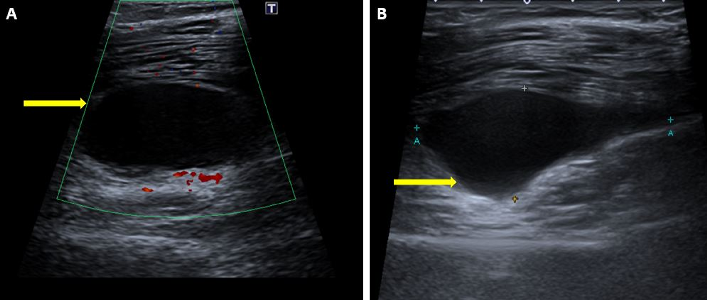 cyst on thigh