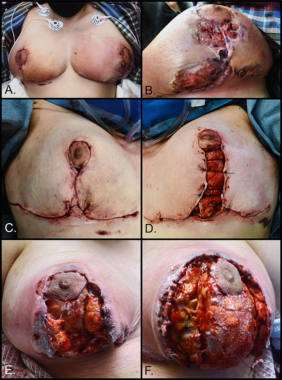 PDF) Necrotizing Cutaneous Fungal Infection of the Breast in a