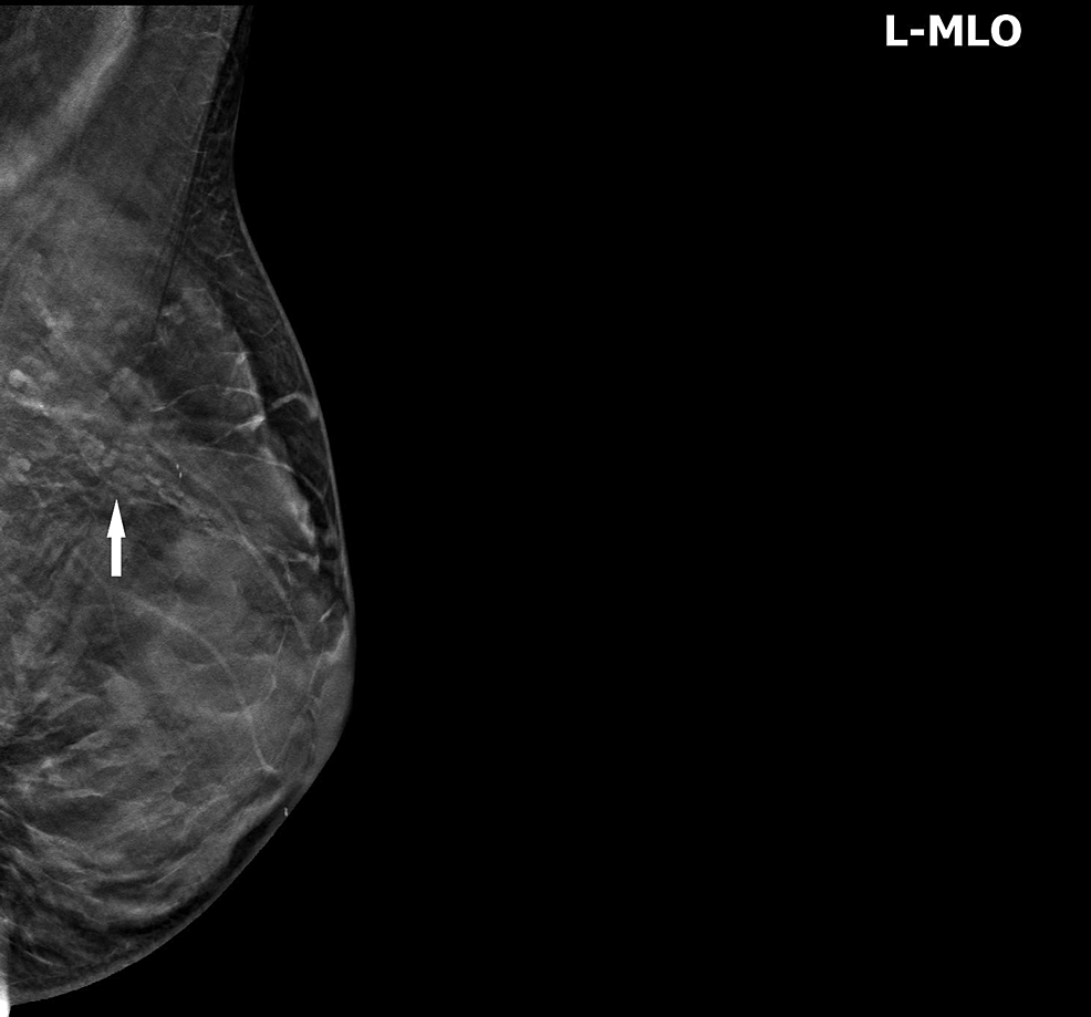 Cureus, Pathologic Nipple Discharge: Rare Imaging Presentation
