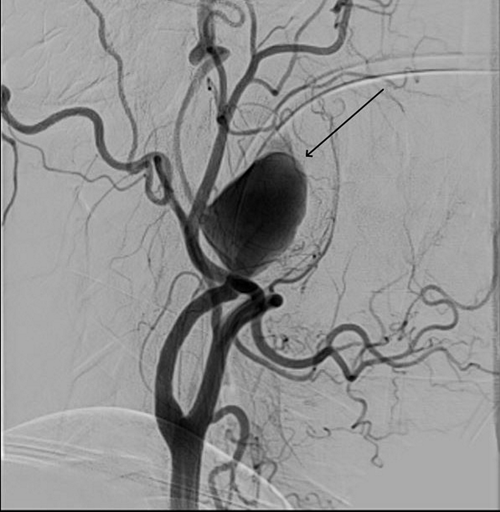 DSA-showing-large-partially-thrombosed-wide-necked-cervical-ICA-aneurysm
