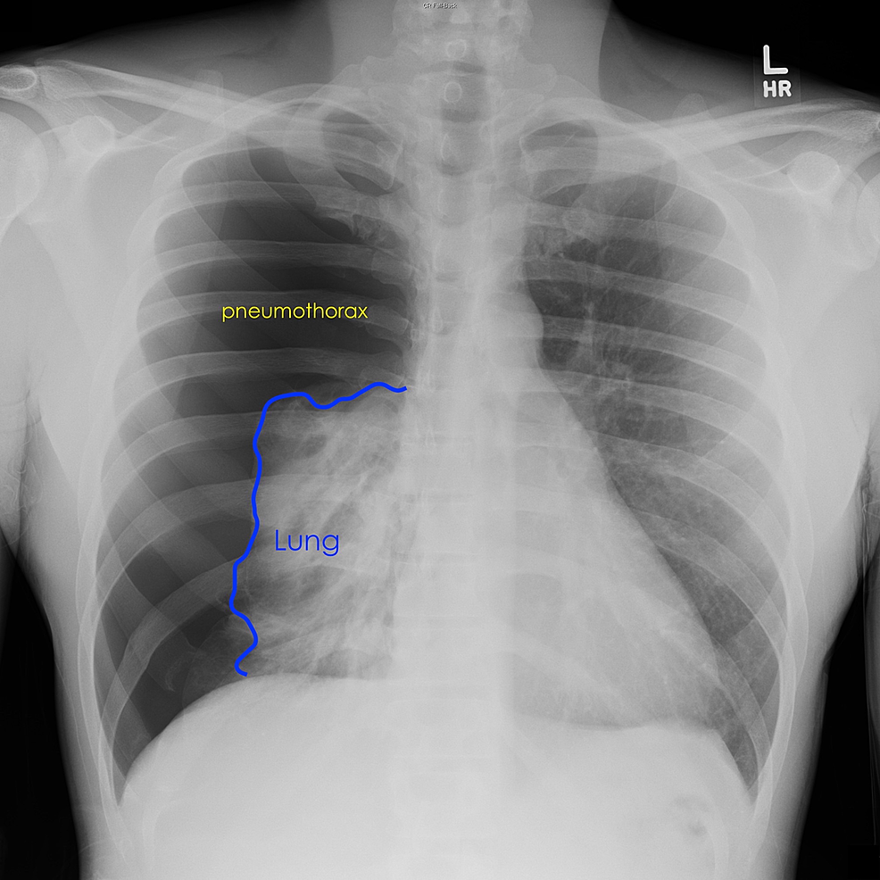 Cureus | Massive Spontaneous Pneumothorax