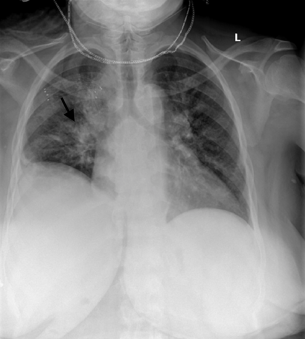 Multisystem Inflammatory Syndrome in Adults or Hemophagocytic