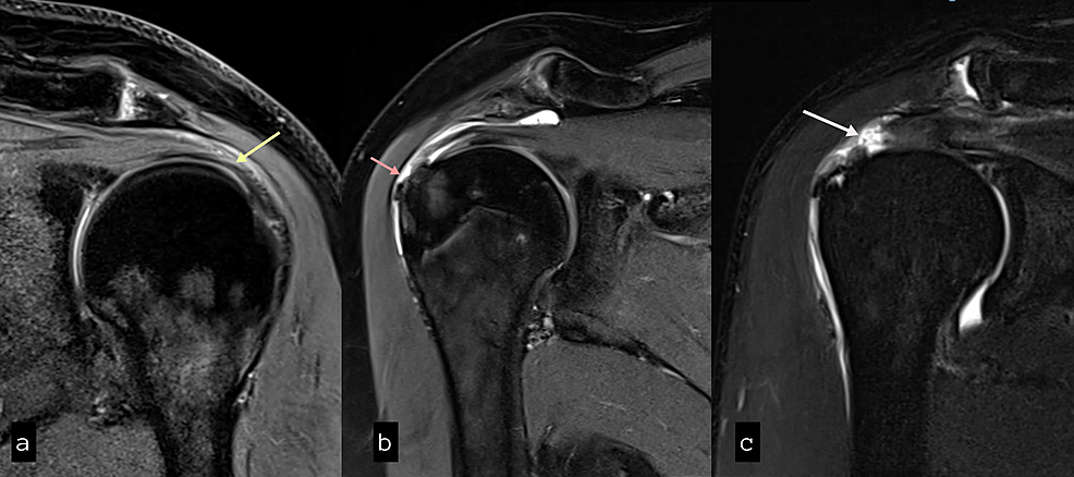Cureus, Role of Magnetic Resonance Imaging in the Evaluation of Rotator  Cuff Tears