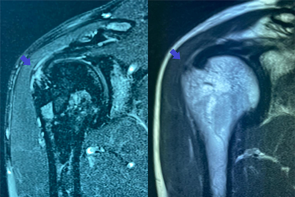 Cureus UltrasoundGuided Injection of a Hyaluronic
