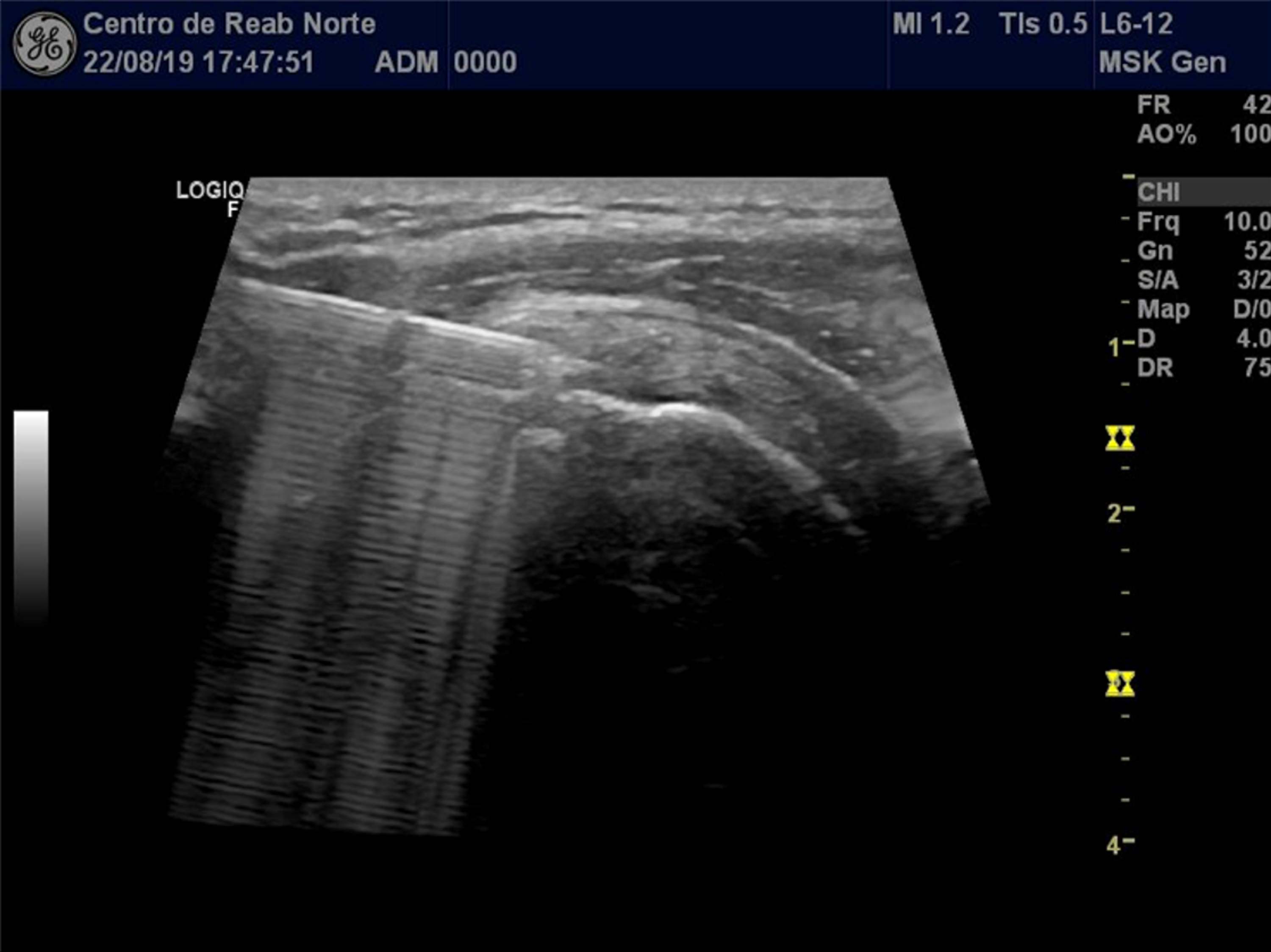 UltrasoundGuided Injection of a Hyaluronic Acid