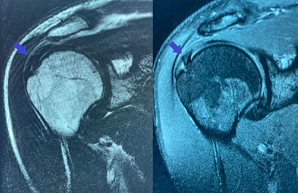 UltrasoundGuided Injection of a Hyaluronic Acid