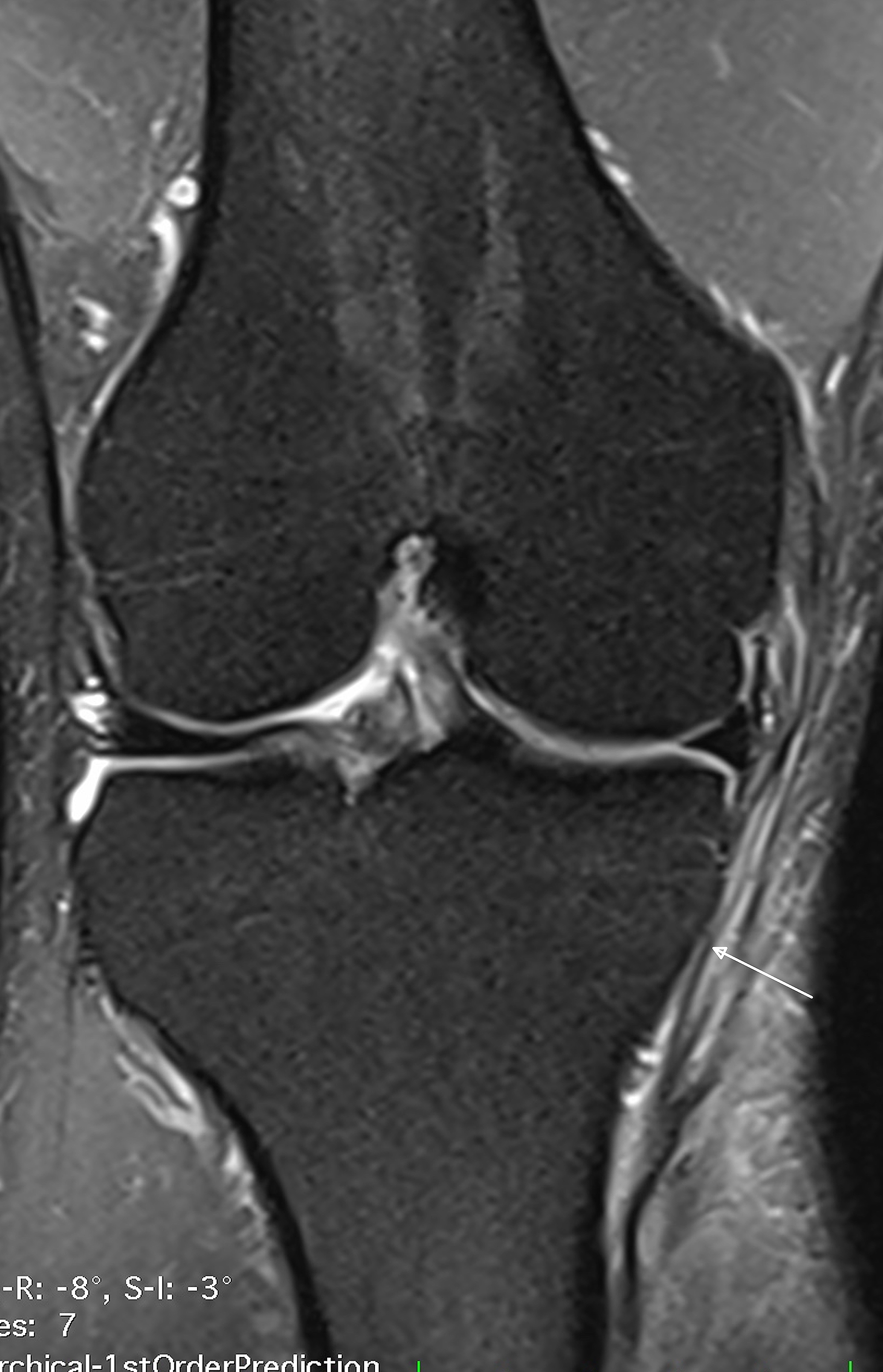 cureus-grade-iii-distal-medial-collateral-ligament-tear-missed-by