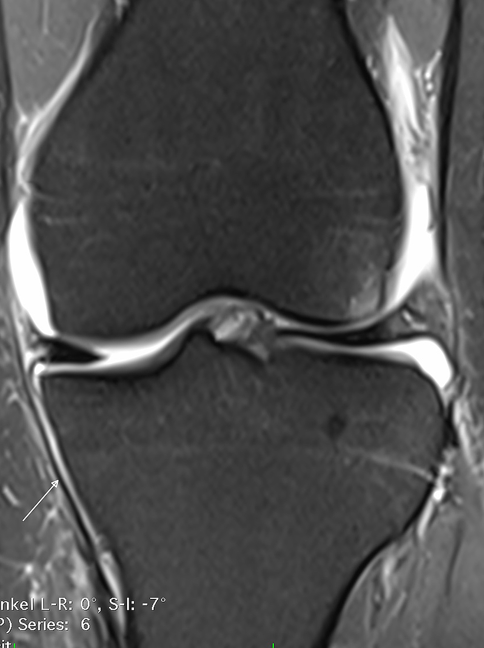 Cureus | Grade III Distal Medial Collateral Ligament Tear ...