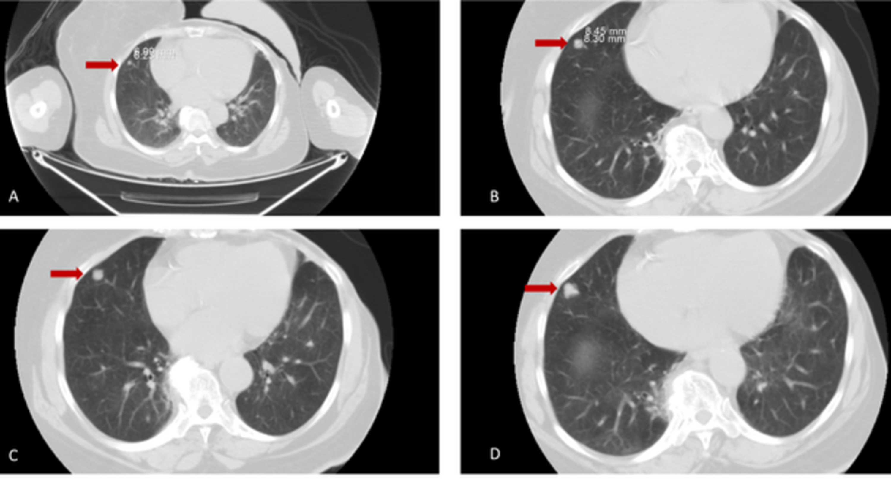Cureus Spindle Cell Hemangioma of the Lung A Case Report