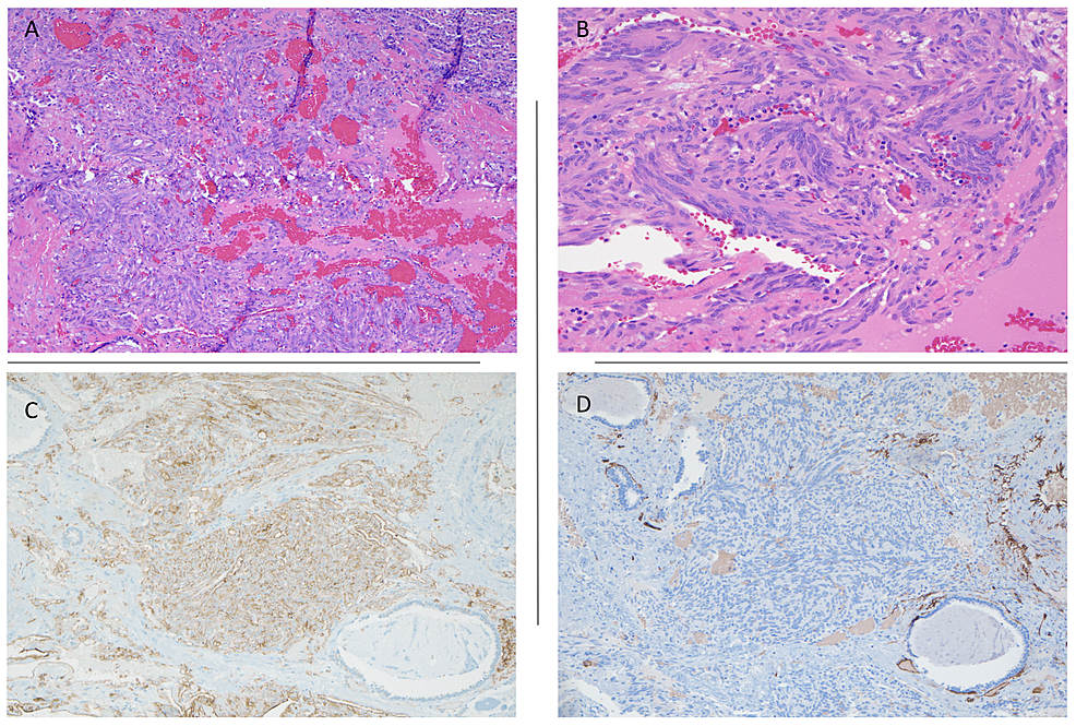 Cureus Spindle Cell Hemangioma of the Lung A Case Report