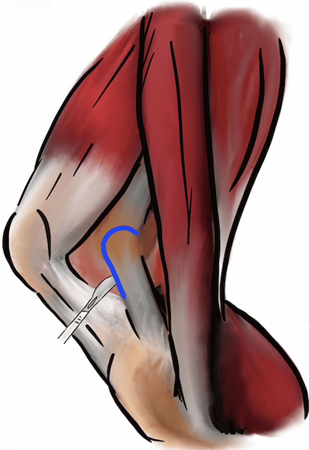 Elevating Knee After Surgery  Jacksonville Orthopaedic Institute