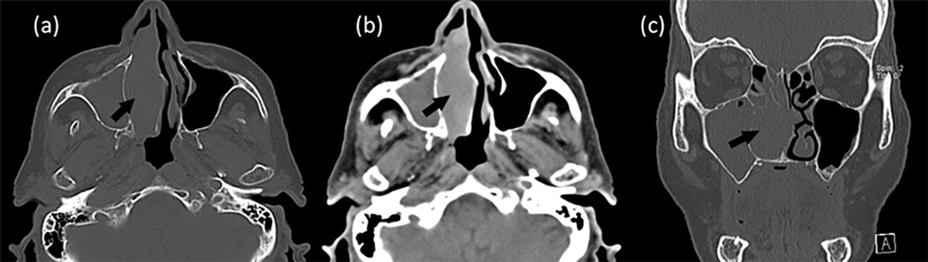 Cureus | An Unusual Polypoid Septal Mucosal Melanoma: Overview and ...