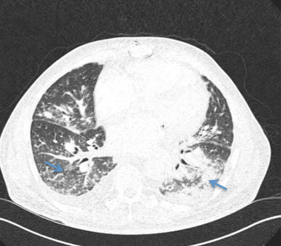 Immunodeficiency A Protective Factor For COVID 19