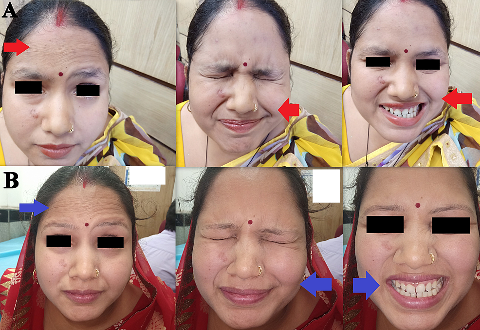 https://assets.cureus.com/uploads/figure/file/306028/article_river_3e75b3d0687b11ecb676dfbe2c95cb3a-Bell-s-palsy-before-and-after-rehabilitation.png