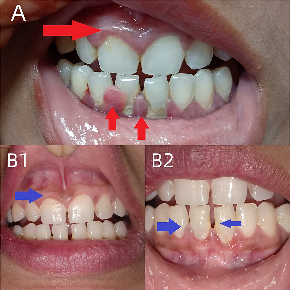 Cureus Vitamin C Deficiency as a Risk Factor for Bell’s Palsy A New
