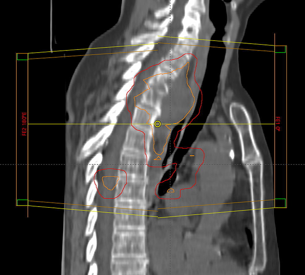 Cureus | A Case Of Five-Year Survival After Combined-Modality Treatment ...