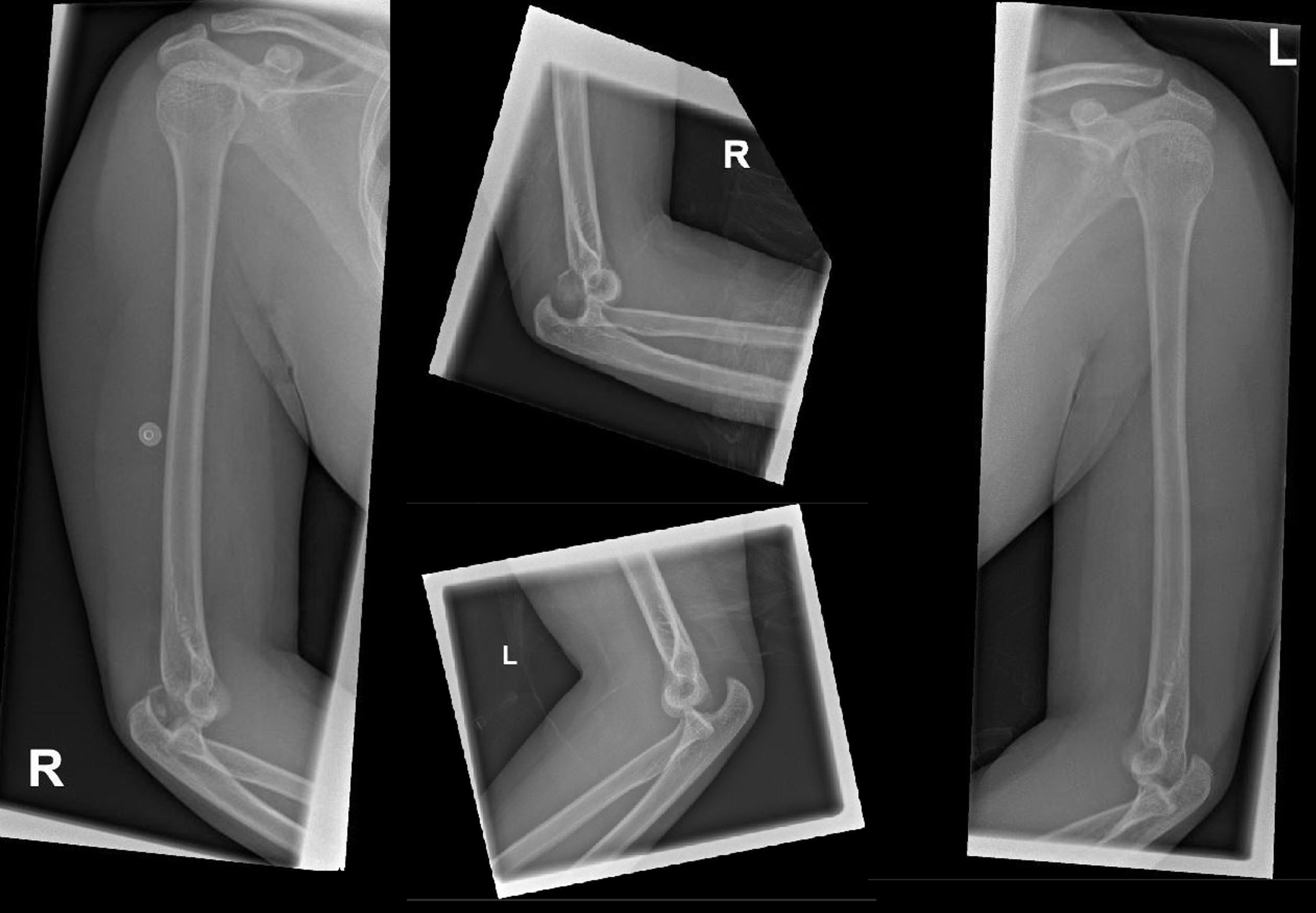 Cureus | Bilateral Elbow Dislocation After Trauma In A Healthy Adult Female