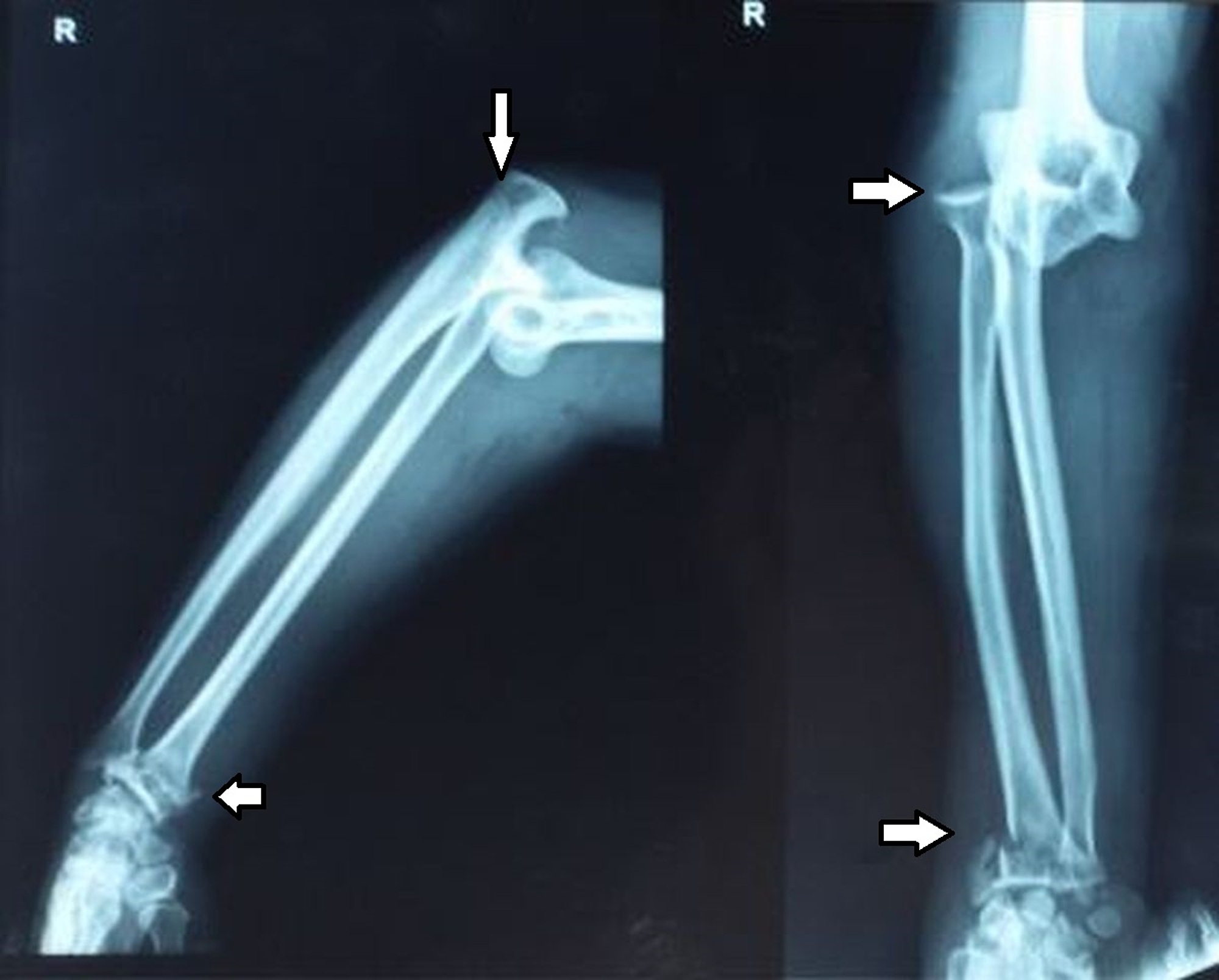 Cureus Concomitant Posterolateral Elbow Dislocation With Ipsilateral Comminuted Intra Articular Distal Radius Fracture A Rare Orthopaedic Scenario