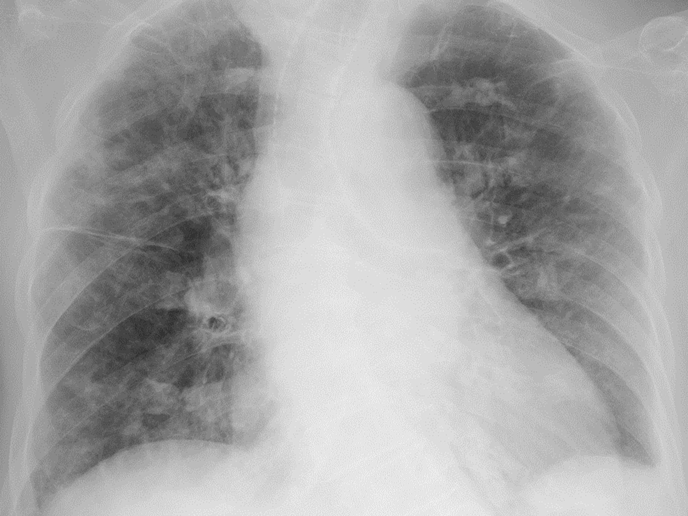 Initial-chest-radiograph-showing-bilateral-pulmonary-infiltrates