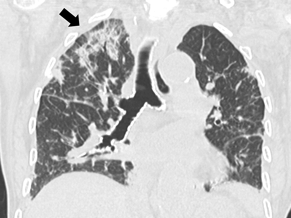 Initial-chest-computed-tomography-showing-bilateral-pulmonary-infiltrates-predominantly-on-the-right-lung