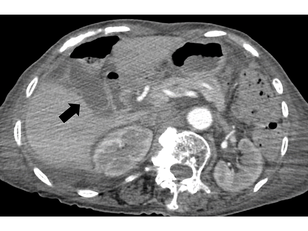 Contrast-enhanced-abdominal-computed-tomography-revealing-gallbladder-edema-without-strong-wall-enhancement