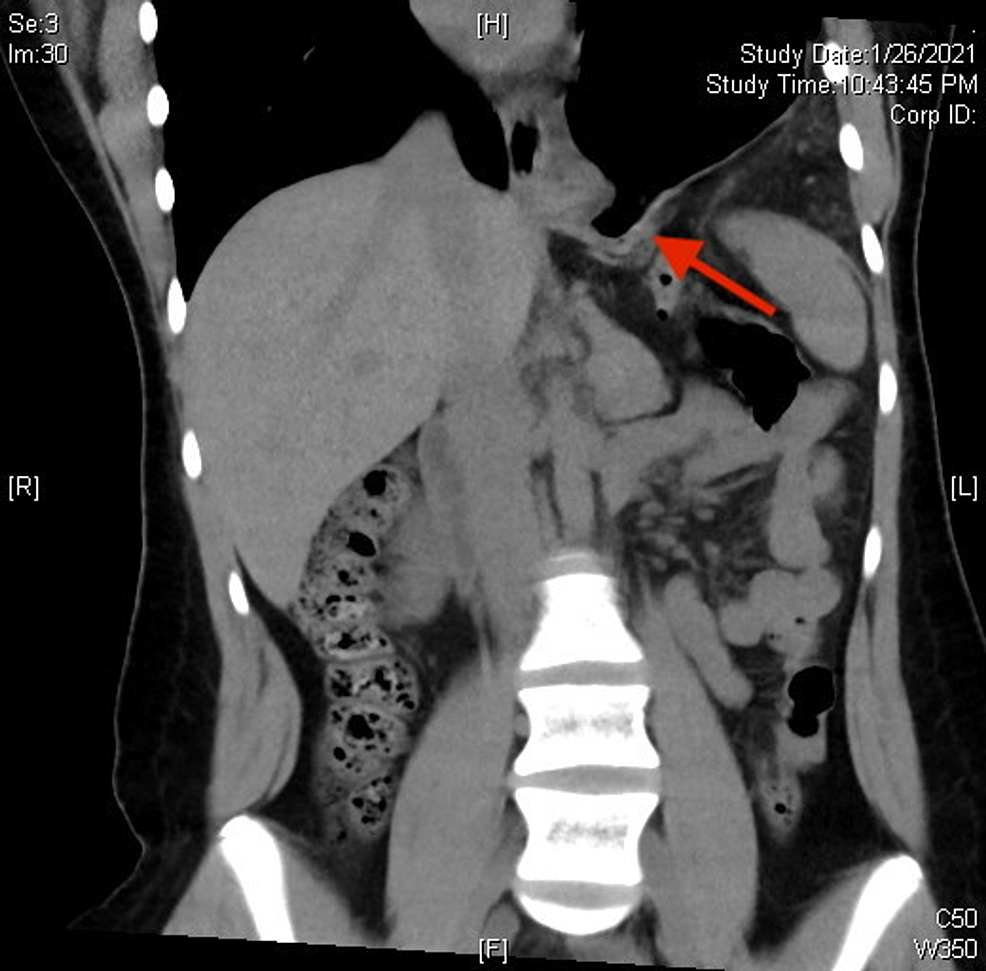 CT-scan-showing-bowel-passing-through-the-diaphragmatic-defect-into-thoracic-cavity