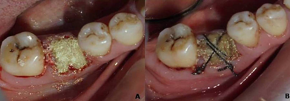 (a)-Graft-mixed-with-platelet-rich-fibrin-placed-in-the-extraction-socket-and-(b)-chorion-membrane-placement-and-secured-with-sutures.