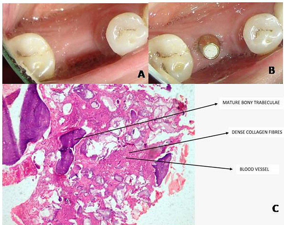 (a)-Six-months-postoperative,-(b)-implant-placements-after-six-months,-(c)-six-months-histological-image-at-x10-for-test-group-and-arrows-represents-mature-bony-trabeculae,-dense-collagen-fibers,-blood-vessels,-and-remnants-of-bone-graft.