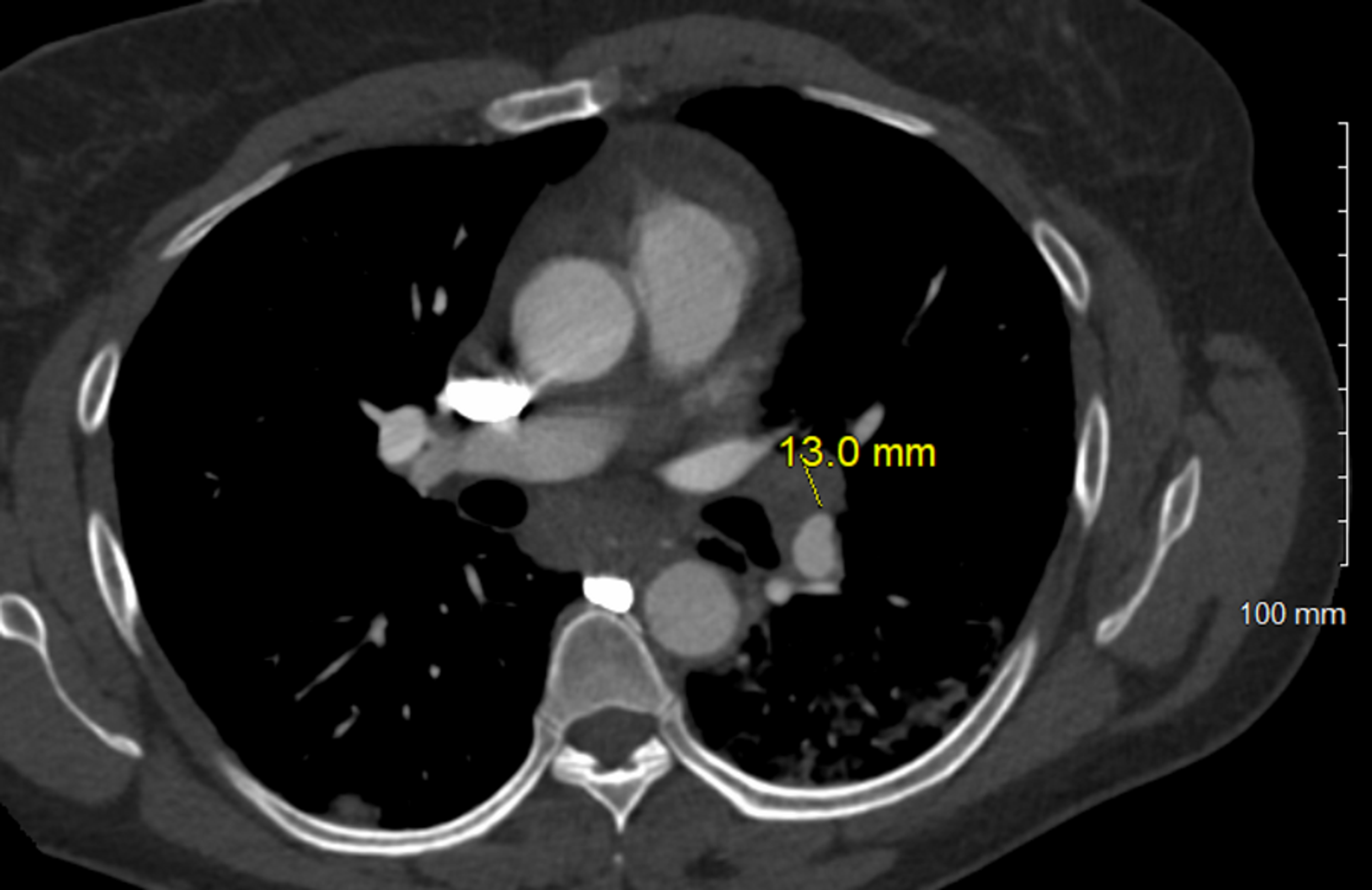 Cureus Can Mediastinal Lymphadenopathy Signal Pericarditis Pericardial Effusion And Severe 