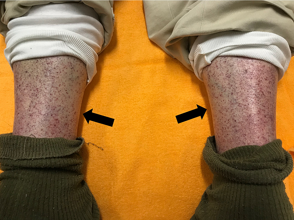 Multiple-petechiae-on-the-bilateral-pretibial-parts.