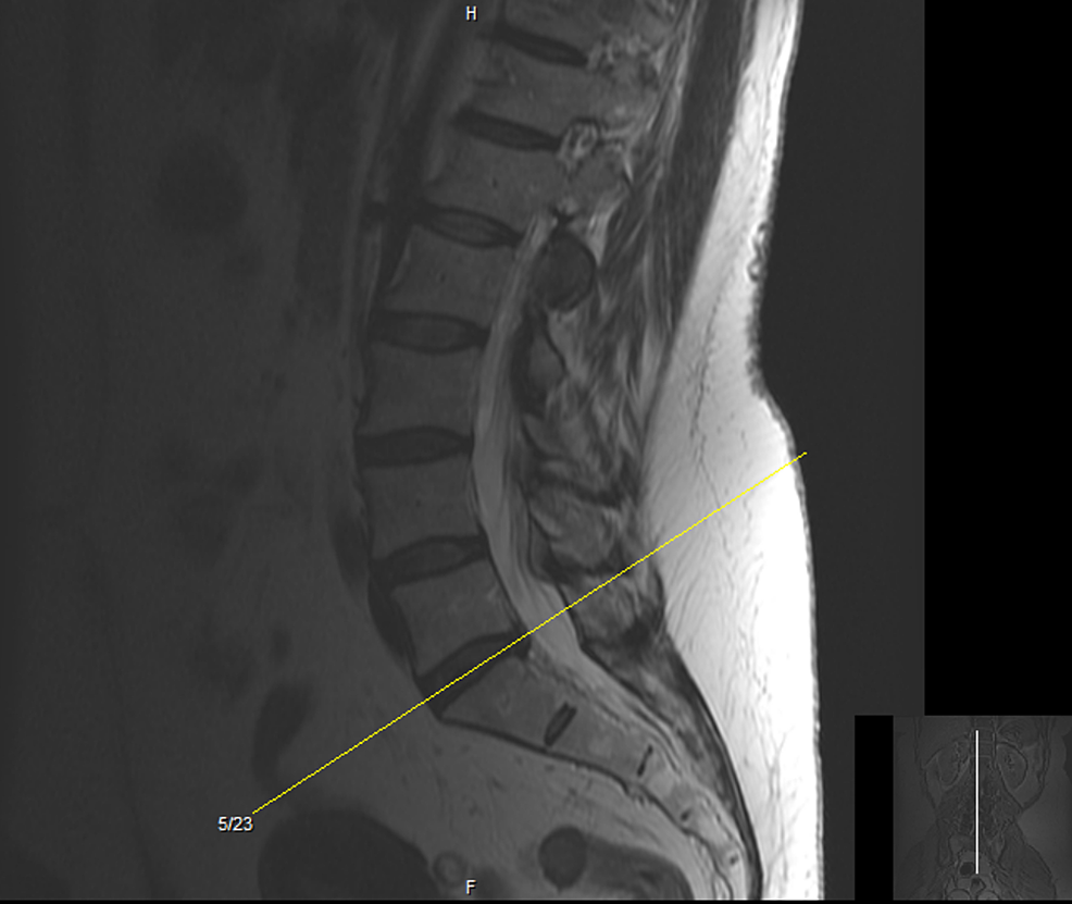 Lumbar-MRI-without-contrast:-sagittal-view.