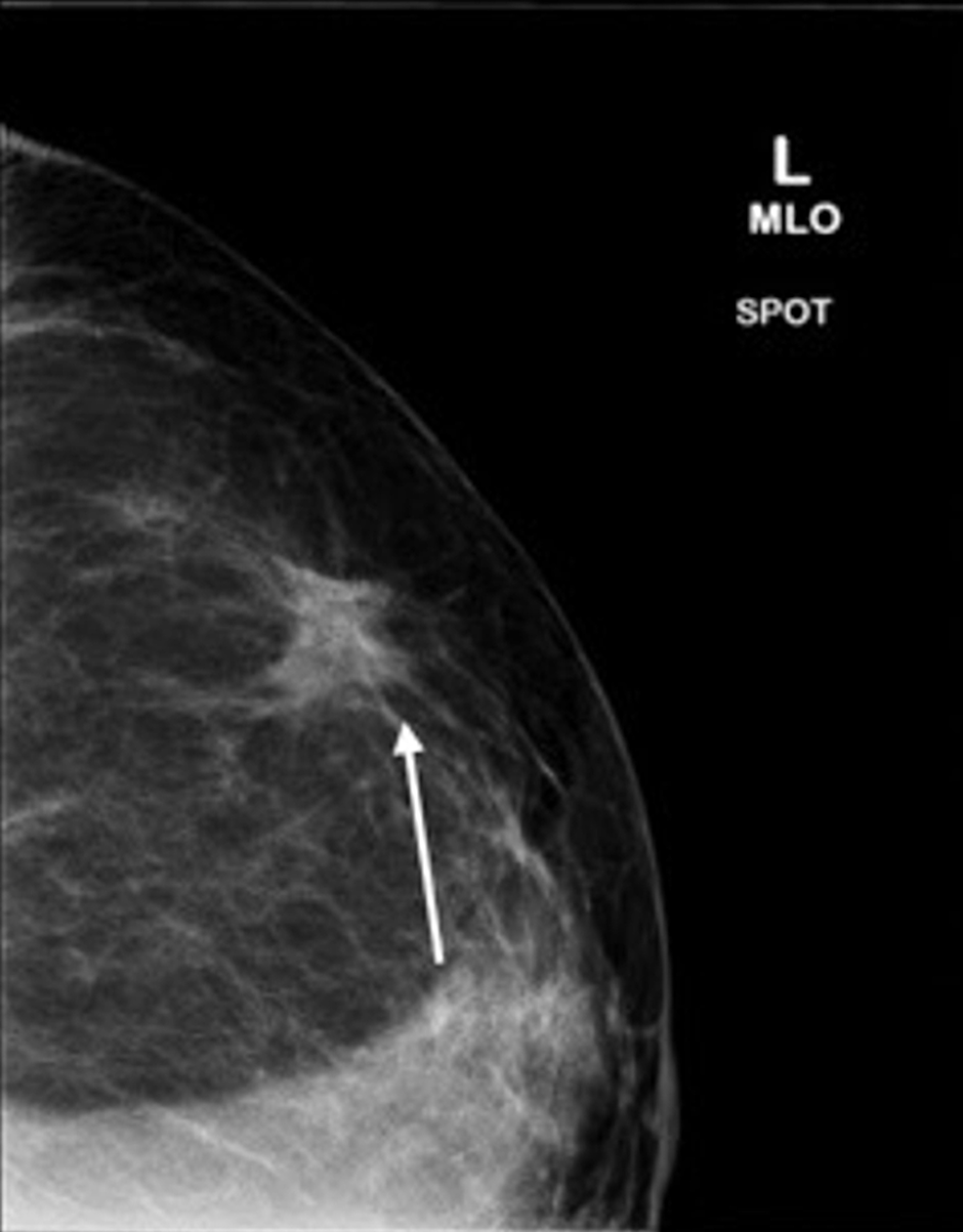 Cureus Multiple Primary Malignant Neoplasms In African Americans A