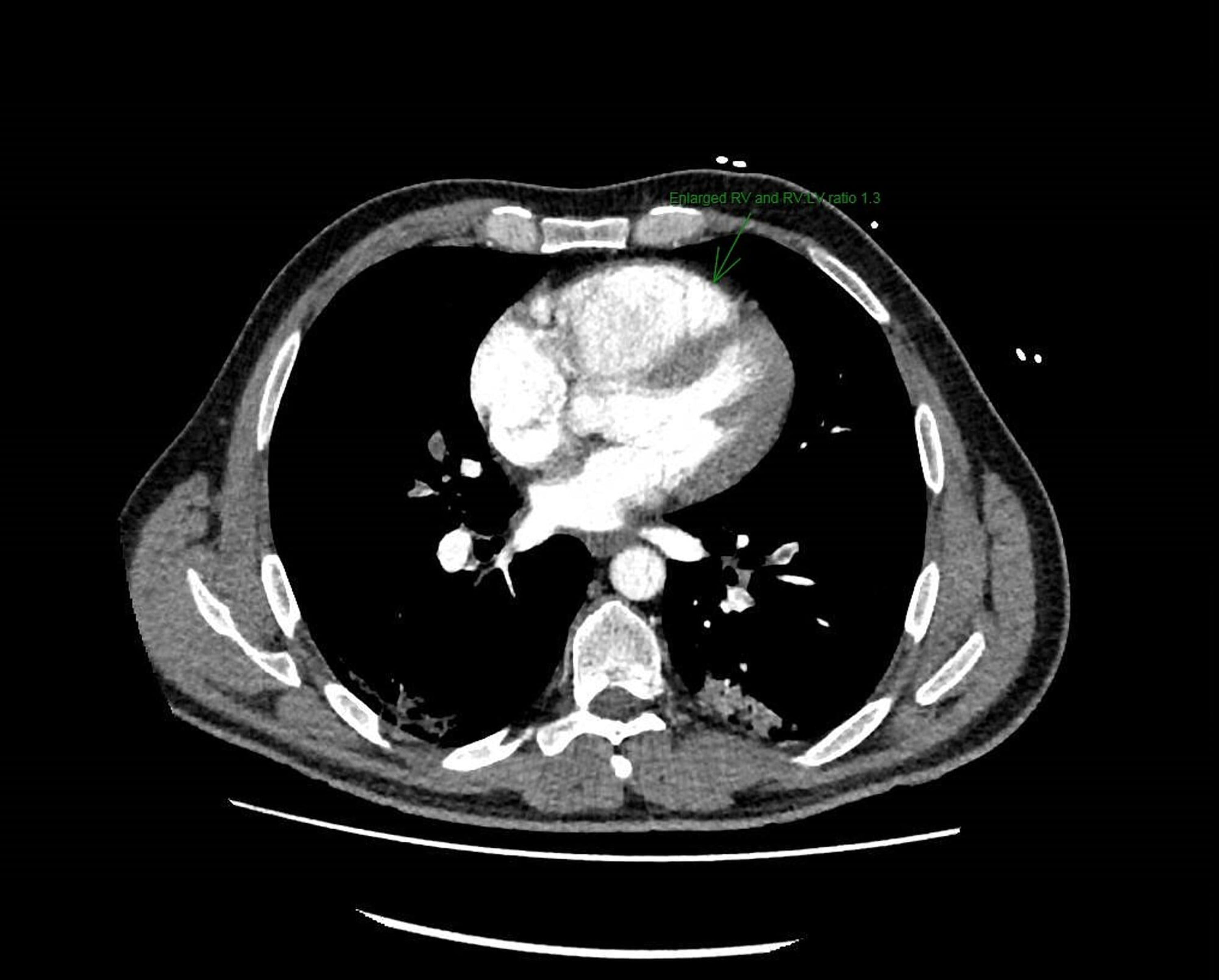 Cureus | EkoSonic™ Endovascular System-Directed Thrombolysis in a ...