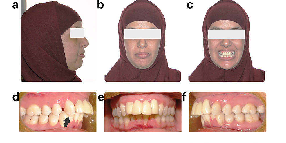 A Multidisciplinary Approach to Congenitally Missing Central Incisors ...