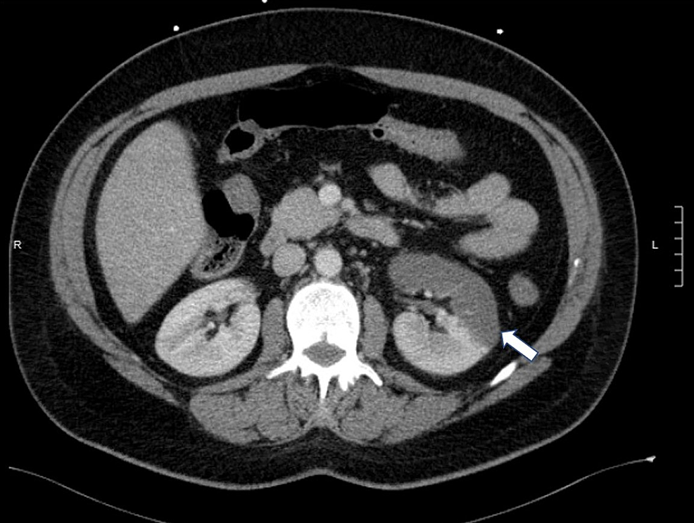 Acute Renal Infarction Heralds New-Onset Paroxysmal Atrial 