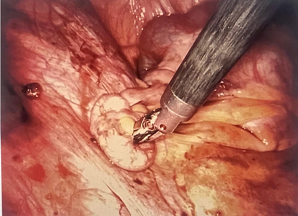 Laparoscopic-image-showing-extensive-endometriotic-implants-on-the-pelvic-wall,-ovarian-ligament,-and-uterosacral-ligament.-