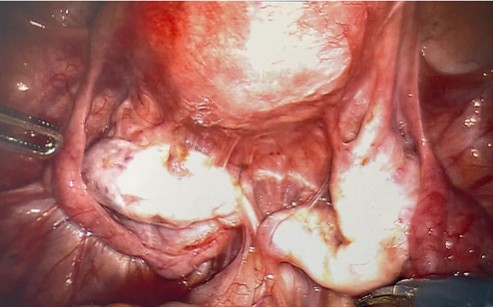 Bilateral-ovaries-and-uterus-six-months-s/p-ovarian-endometrioma-cystectomy.-Diffuse-adhesions-present.-